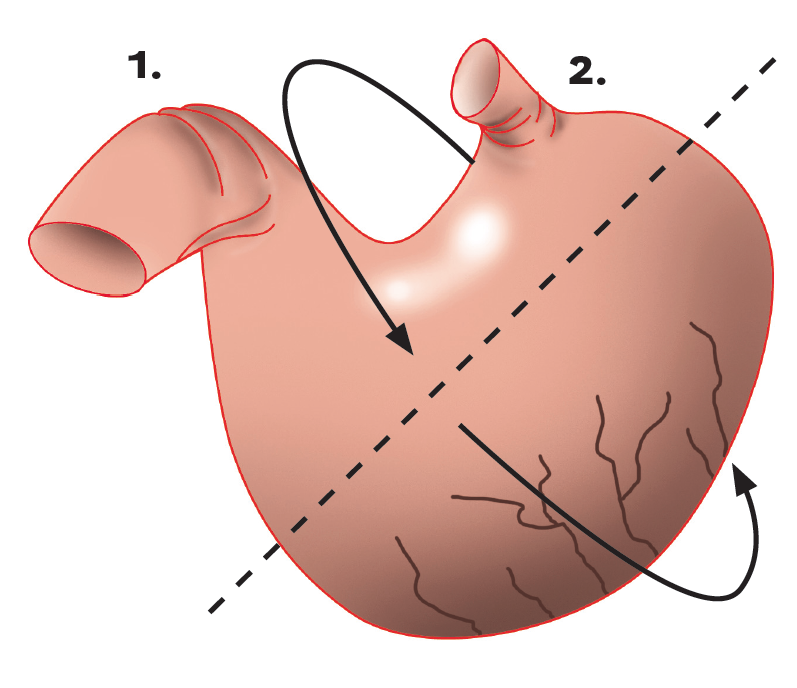 Η στροφή του στομάχου προκαλεί σύγκλειση -δηλαδή κλείσιμο- του καρδιακού (2) και του πυλωρικού (1) στομίου.